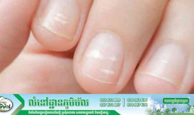 តើផ្កាក្រចក កើតឡើងដោយសារអ្វី?