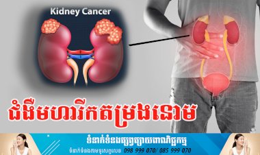 ប្រធានបទ ៖ ជំងឺមហារីកតម្រងនោម