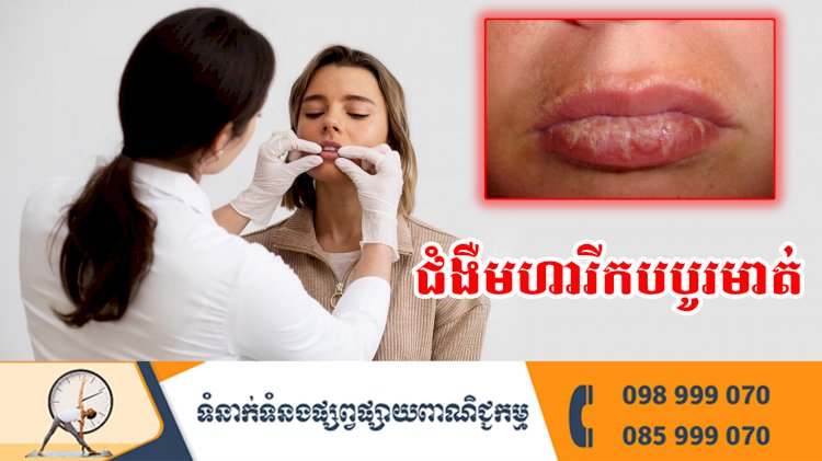 ប្រធានបទ ៖ ជំងឺមហារីកបបូរមាត់